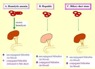 bilirubina 1 in urina|Bilirubin In Urine: Causes And What It Indicates 